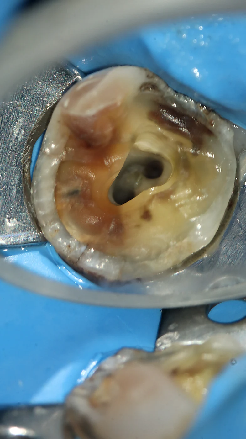 Molar con restauración fracturada antes de endodoncia