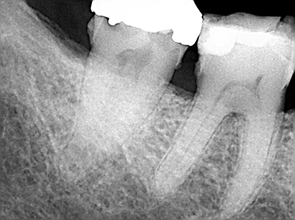 Radiografía de molar con infección interna antes de endodoncia