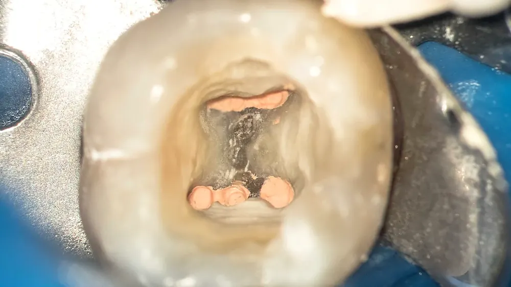 Conductos obturados y sellados tras endodoncia en Caracas